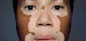 vitiligo